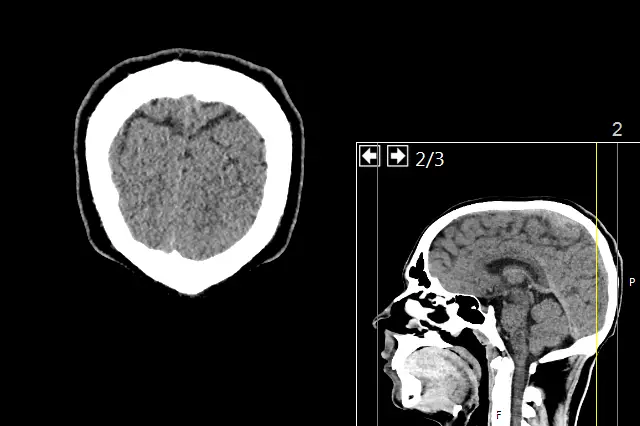 psychology photo of maybe a psychologist's brain, likely a smart person with great resume skills https://upload.wikimedia.org/wikipedia/commons/9/9c/CT_of_a_normal_brain%2C_coronal_53.png